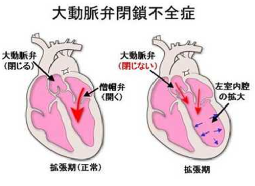 大動脈弁閉鎖不全の症状は何ですか?