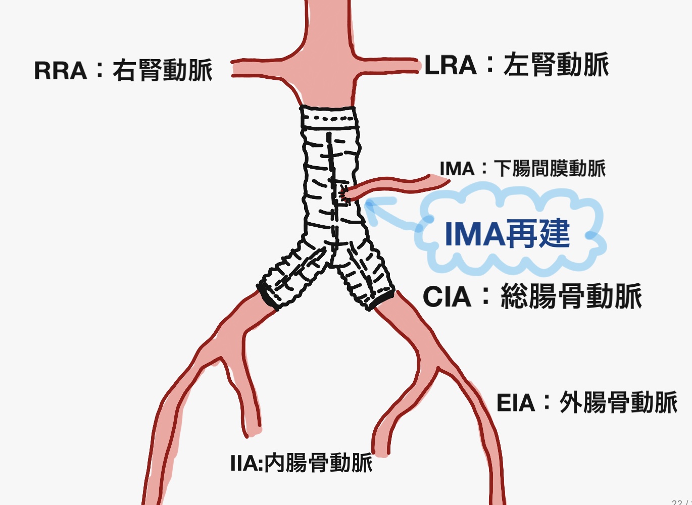 下腸間膜動脈