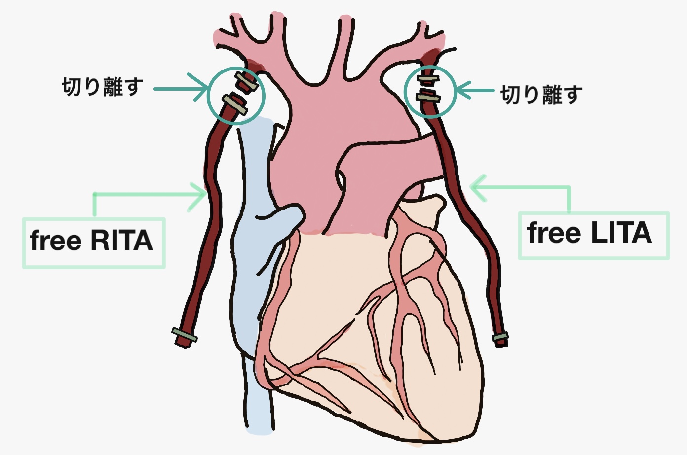 【よく使われる用語】冠動脈バイパス術（CABG）の手術介助④